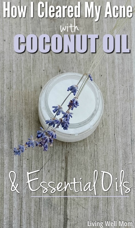 Had enough of dealing with adult acne or blemishes? Find out how I cleared my acne all-naturally, using coconut oil and essential oils. (My skin has never been clearer!)