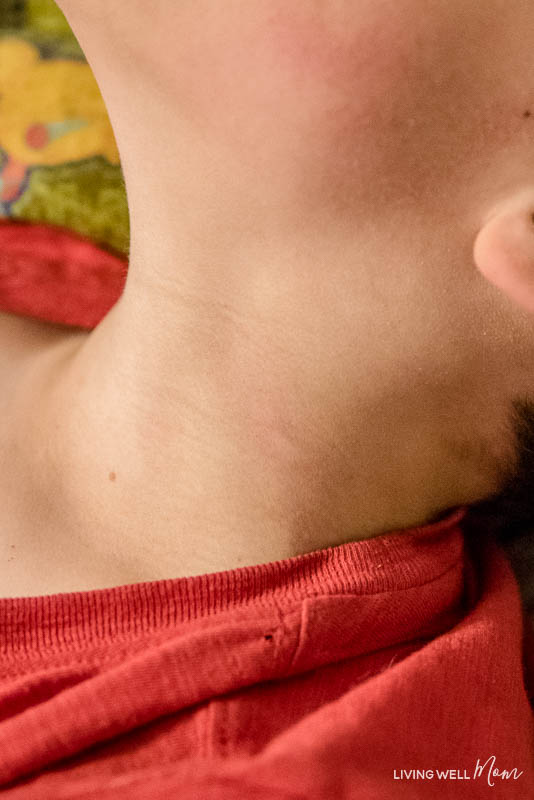 a bee sting on a boys neck