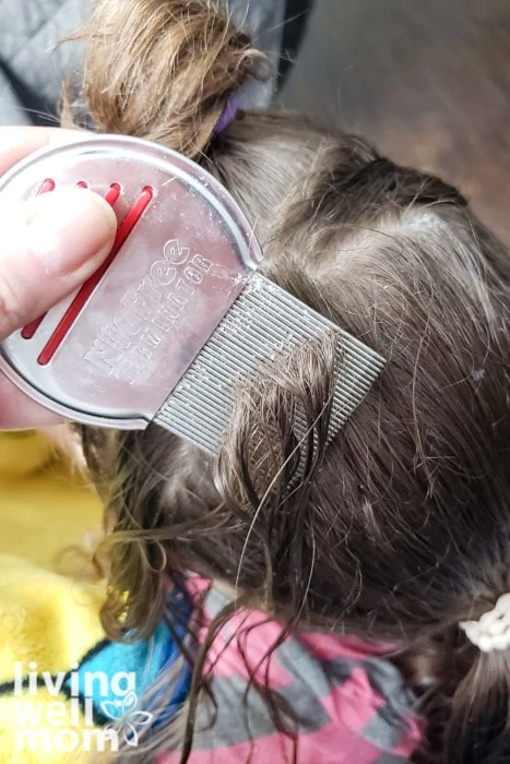 Combing out nits during a natural lice treatment at home