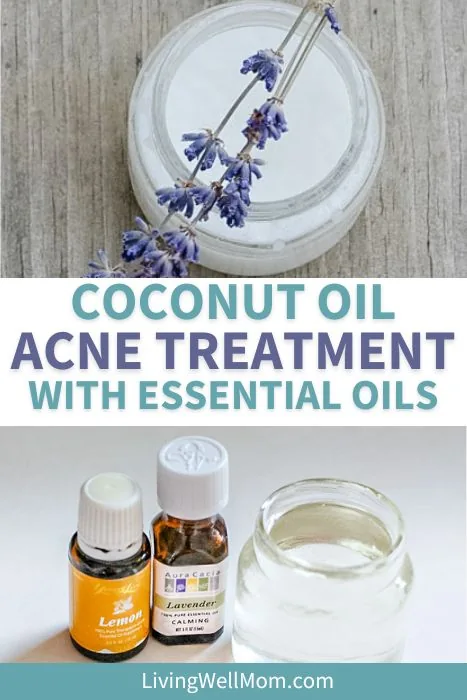 coconut oil acne treatment with essential oils pin