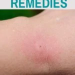 bug bite remedies