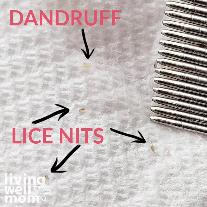 How To Get Rid Of Lice Nits Without Chemicals Living Well Mom