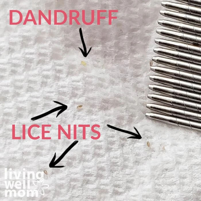 Visual showing how to tell the difference between dandruff and lice nits by using a paper towel.